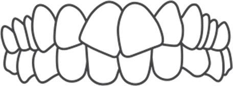 前歯の叢生